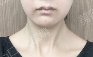 治療直後の症例写真