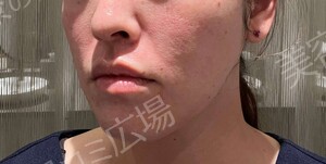治療直後の症例写真