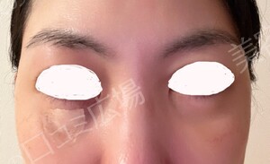 治療直後の症例写真