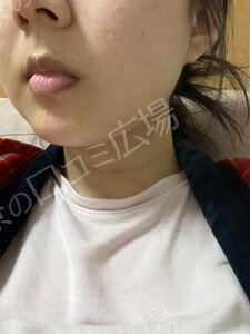 治療直後の症例写真