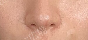 治療直後の症例写真