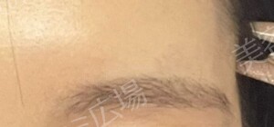【口コミ広場期間限定価格】韓国製ボトックス｜1部位の治療結果の症例写真
