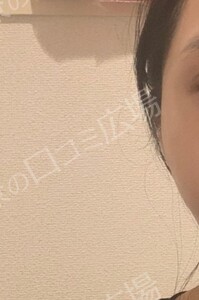 治療直後の症例写真