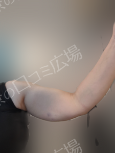 脂肪溶解注射｜エクリリス10ccの治療前の症例写真