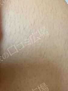 口コミ広場会員様限定！全身脱毛5回コース 146,300円の治療前の症例写真