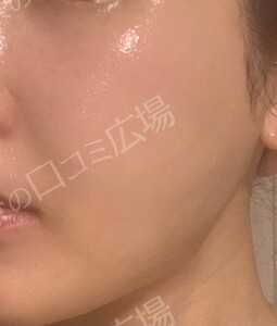 ジェネシスの治療結果の症例写真