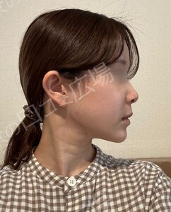 貴族手術（鼻翼基部プロテーゼ）｜ほうれい線を改善の治療直後の症例写真
