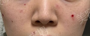 治療直後の症例写真