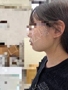 治療直後の症例写真