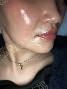 治療直後の症例写真