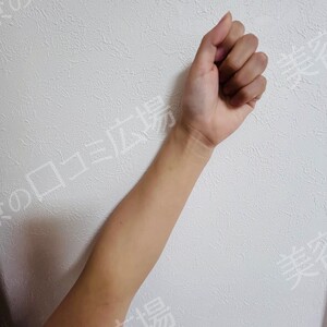 白玉ハイパー点滴（高濃度グルタチオン1200㎎）の治療結果の症例写真