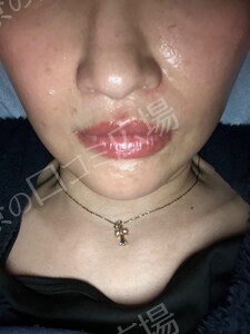 治療直後の症例写真