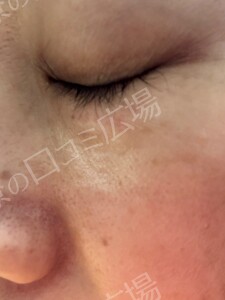治療直後の症例写真