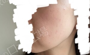 治療結果の症例写真