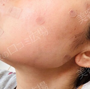 治療直後の症例写真