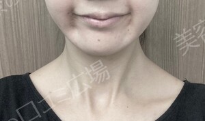 治療直後の症例写真