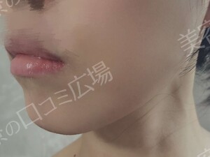 治療直後の症例写真