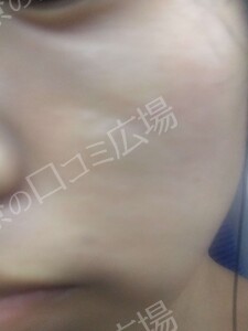 治療直後の症例写真