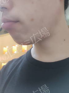 治療直後の症例写真