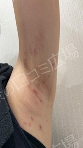 治療直後の症例写真