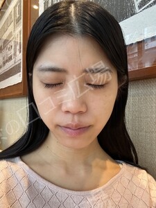 治療前の症例写真