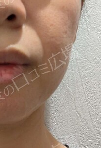 エラボトックス｜咬筋の張りとフェイスラインの治療結果の症例写真