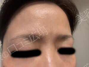 CLINIC Wのリフトアップの症例写真[ビフォー]