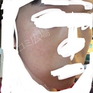 治療直後の症例写真