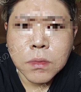 治療直後の症例写真