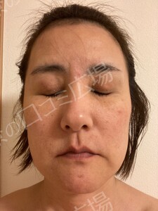 治療直後の症例写真
