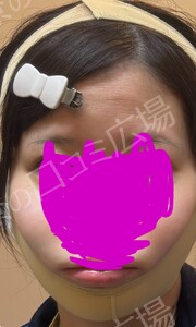 治療直後の症例写真