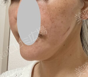 治療直後の症例写真