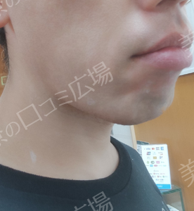 治療直後の症例写真