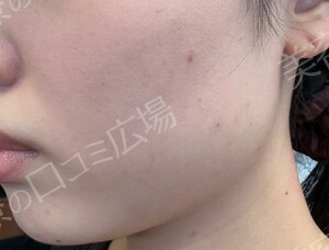 治療直後の症例写真