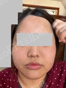 治療直後の症例写真