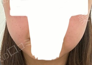 治療直後の症例写真