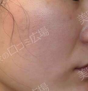 治療直後の症例写真