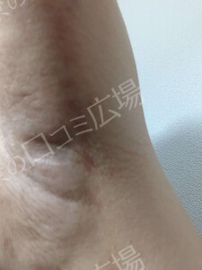 治療直後の症例写真
