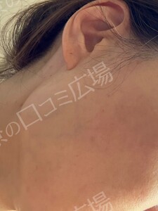 治療直後の症例写真