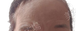 治療直後の症例写真