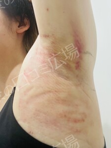 治療直後の症例写真
