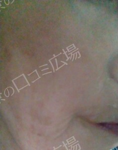 治療前の症例写真