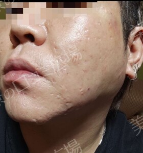 治療直後の症例写真