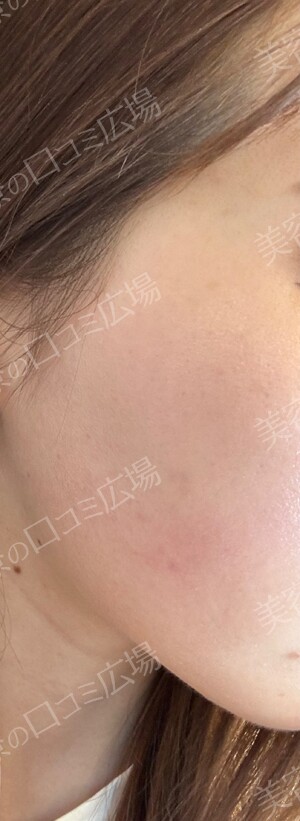 ルラ（LULA）美容クリニック 岡山院のニキビの症例写真[ビフォー]