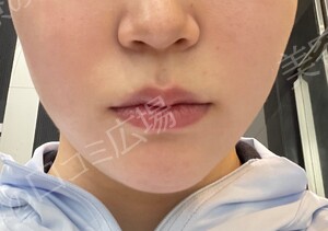 治療直後の症例写真