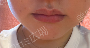 【高崎院限定】初回限定：無料✨｜ピコトーニング｜全顔1回の治療直後の症例写真