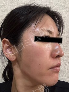 治療直後の症例写真