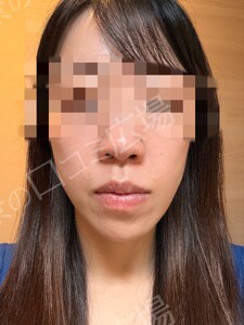 治療直後の症例写真