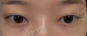 医療法人秀晄会 心斎橋コムロ美容外科クリニックの症例写真[アフター]