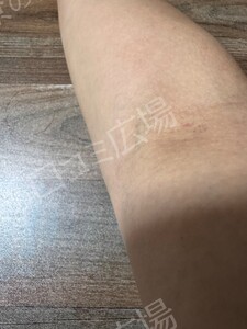 治療直後の症例写真